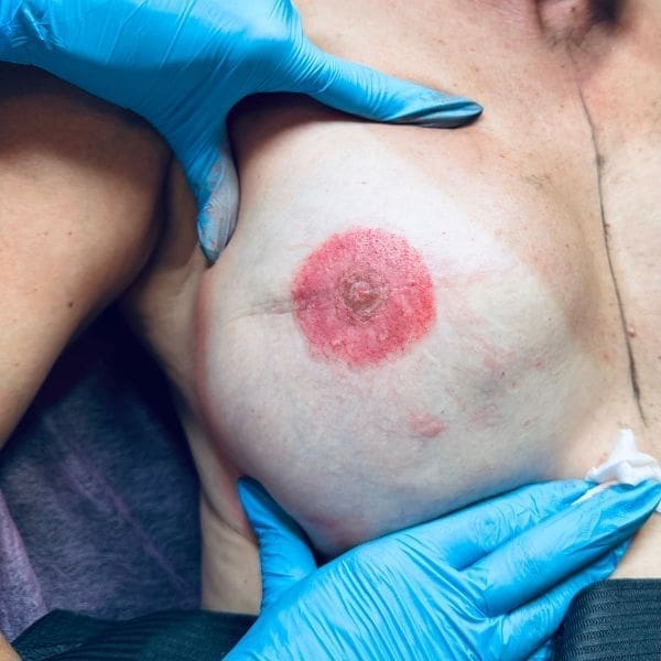Healed 3D areola restoration results