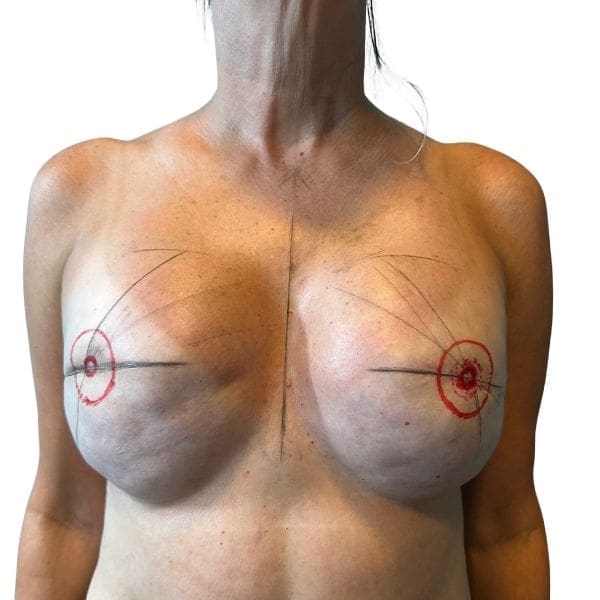 Precision mapping for areola symmetry and placement