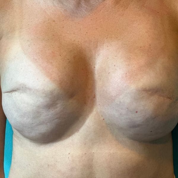 Client assessment for restorative areola tattooing